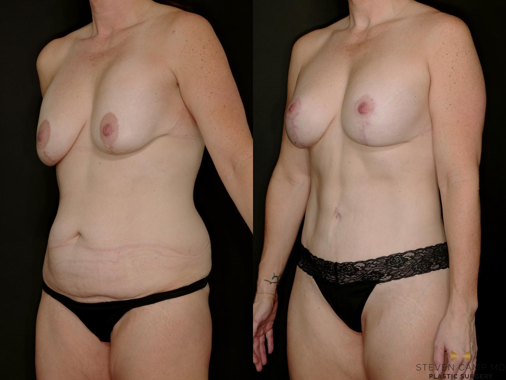 Before & After Mommy Makeover Case 769 Left Oblique View in Fort Worth & Arlington, Texas