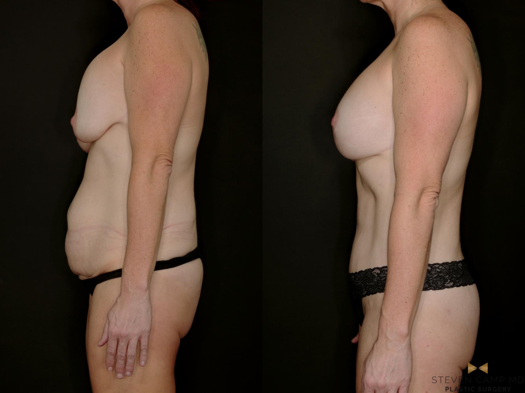 Before & After Mommy Makeover Case 769 Left Side View in Fort Worth & Arlington, Texas