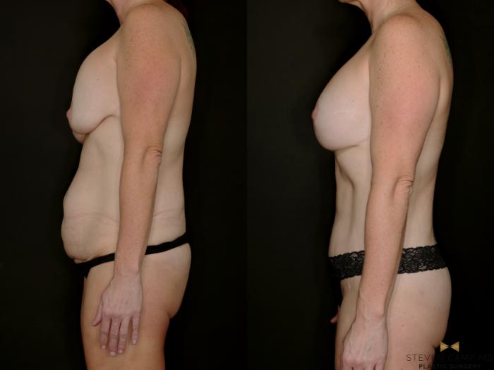 Before & After Mommy Makeover Case 769 Left Side View in Fort Worth & Arlington, Texas