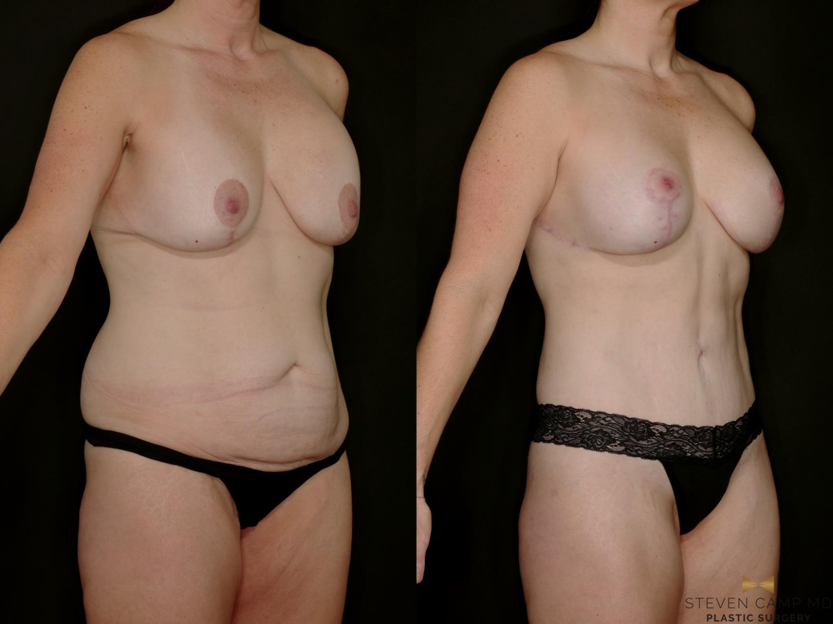 Before & After Mommy Makeover Case 769 Right Oblique View in Fort Worth & Arlington, Texas