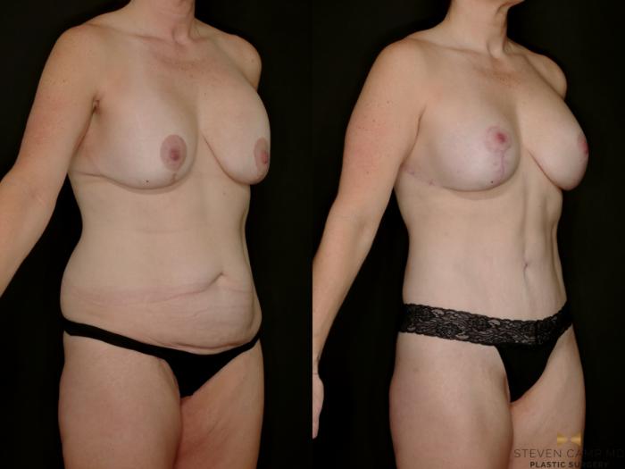 Before & After Mommy Makeover Case 769 Right Oblique View in Fort Worth & Arlington, Texas