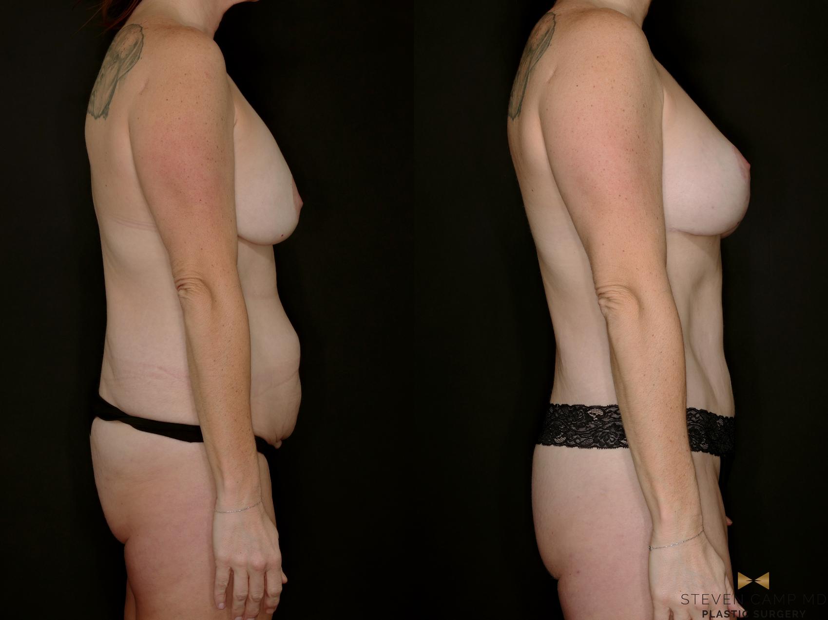 Before & After Mommy Makeover Case 769 Right Side View in Fort Worth & Arlington, Texas