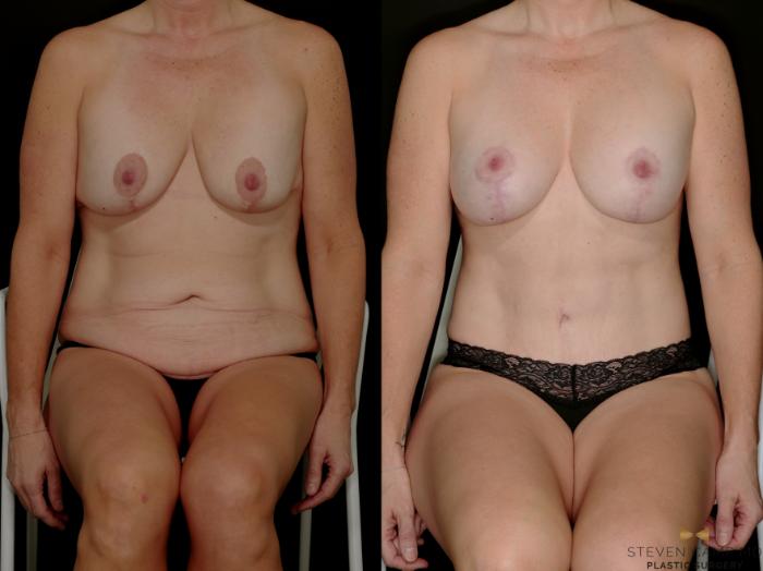 Before & After Mommy Makeover Case 769 Seated View in Fort Worth & Arlington, Texas