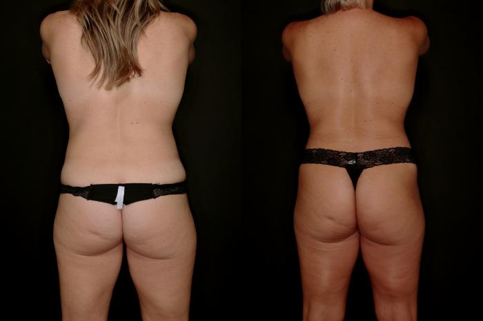 Before & After Mommy Makeover Case 788 Back View in Fort Worth & Arlington, Texas