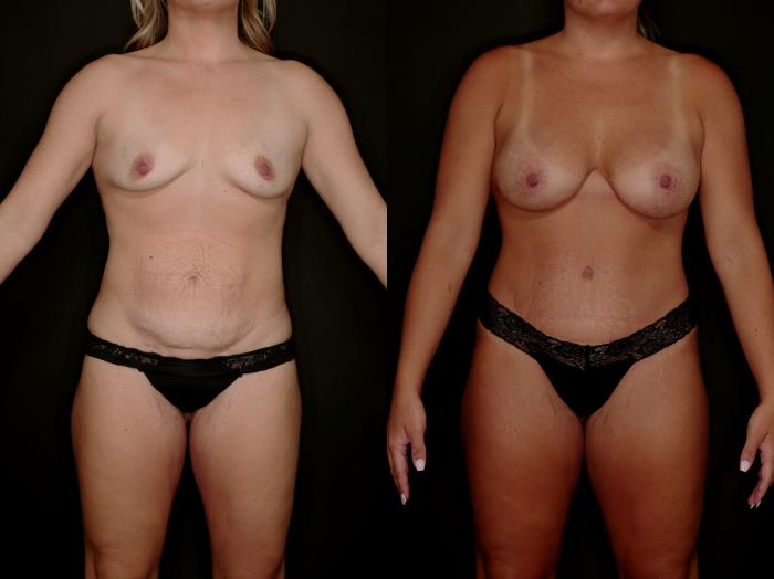 Before & After Mommy Makeover Case 788 Front View in Fort Worth & Arlington, Texas