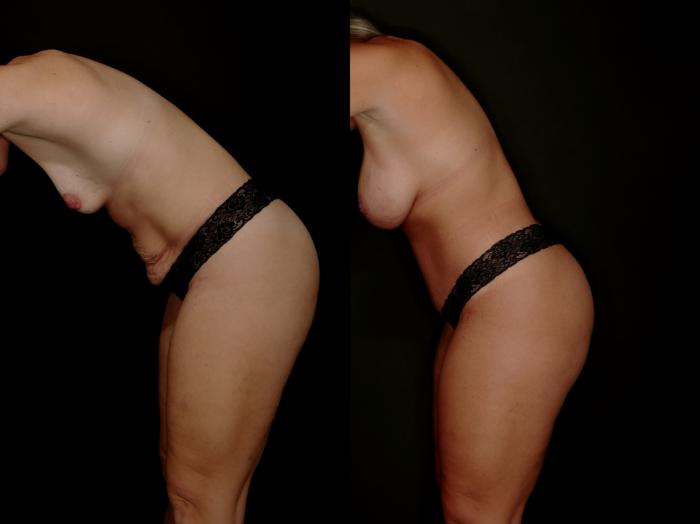 Before & After Mommy Makeover Case 788 Left Diving Pose View in Fort Worth & Arlington, Texas