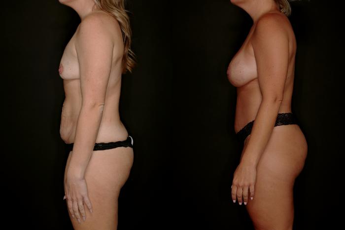 Before & After Mommy Makeover Case 788 Left Side View in Fort Worth & Arlington, Texas
