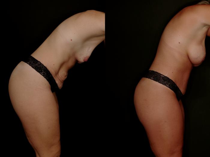 Before & After Mommy Makeover Case 788 Right Diving Pose View in Fort Worth & Arlington, Texas