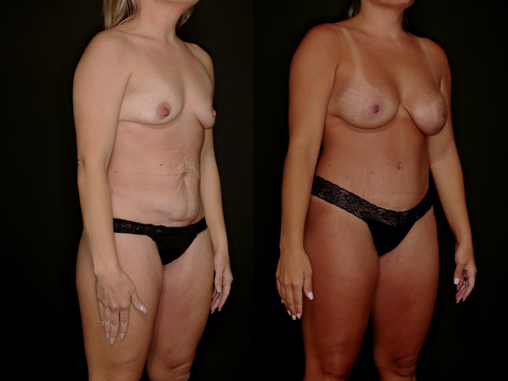 Before & After Mommy Makeover Case 788 Right Oblique View in Fort Worth & Arlington, Texas