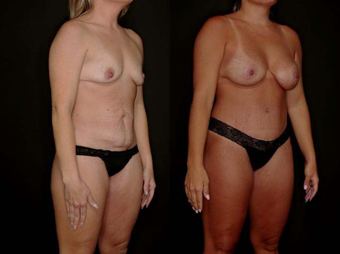 Before & After Mommy Makeover Case 788 Right Oblique View in Fort Worth & Arlington, Texas