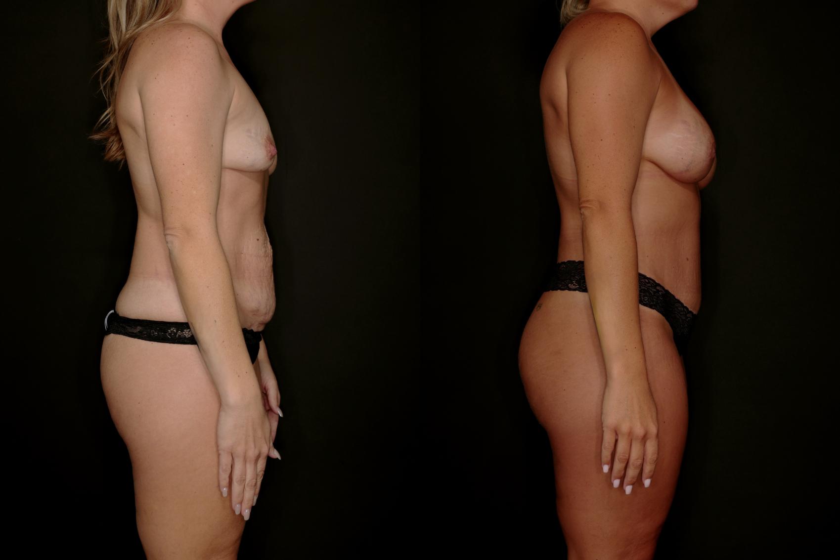 Before & After Mommy Makeover Case 788 Right Side View in Fort Worth & Arlington, Texas