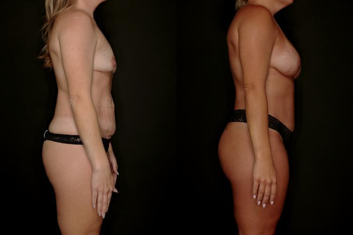 Before & After Mommy Makeover Case 788 Right Side View in Fort Worth & Arlington, Texas