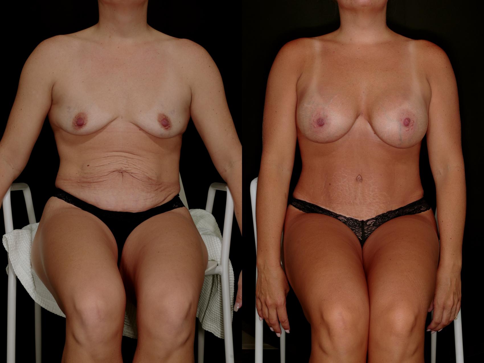 Before & After Mommy Makeover Case 788 Sitting down  View in Fort Worth & Arlington, Texas