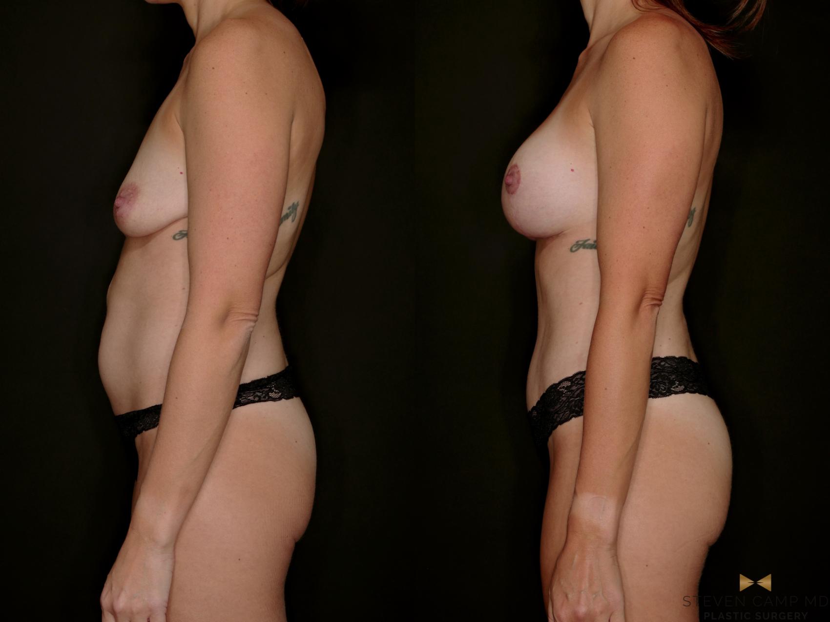 Before & After Mommy Makeover Case 791 Left Side View in Fort Worth & Arlington, Texas
