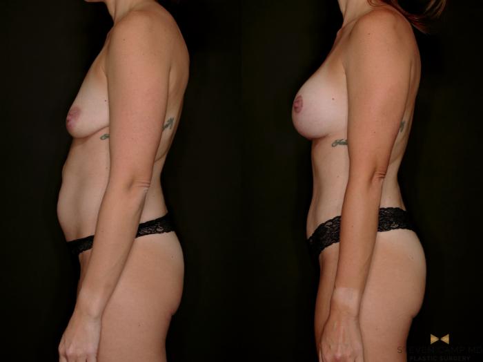 Before & After Mommy Makeover Case 791 Left Side View in Fort Worth & Arlington, Texas