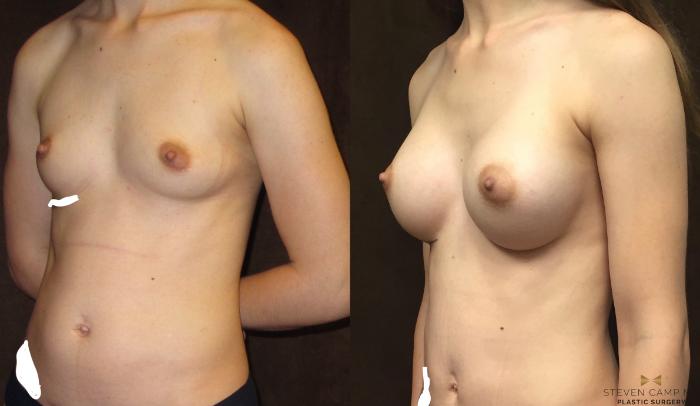 Before & After Tummy Tuck Case 81 View #3 View in Fort Worth & Arlington, Texas