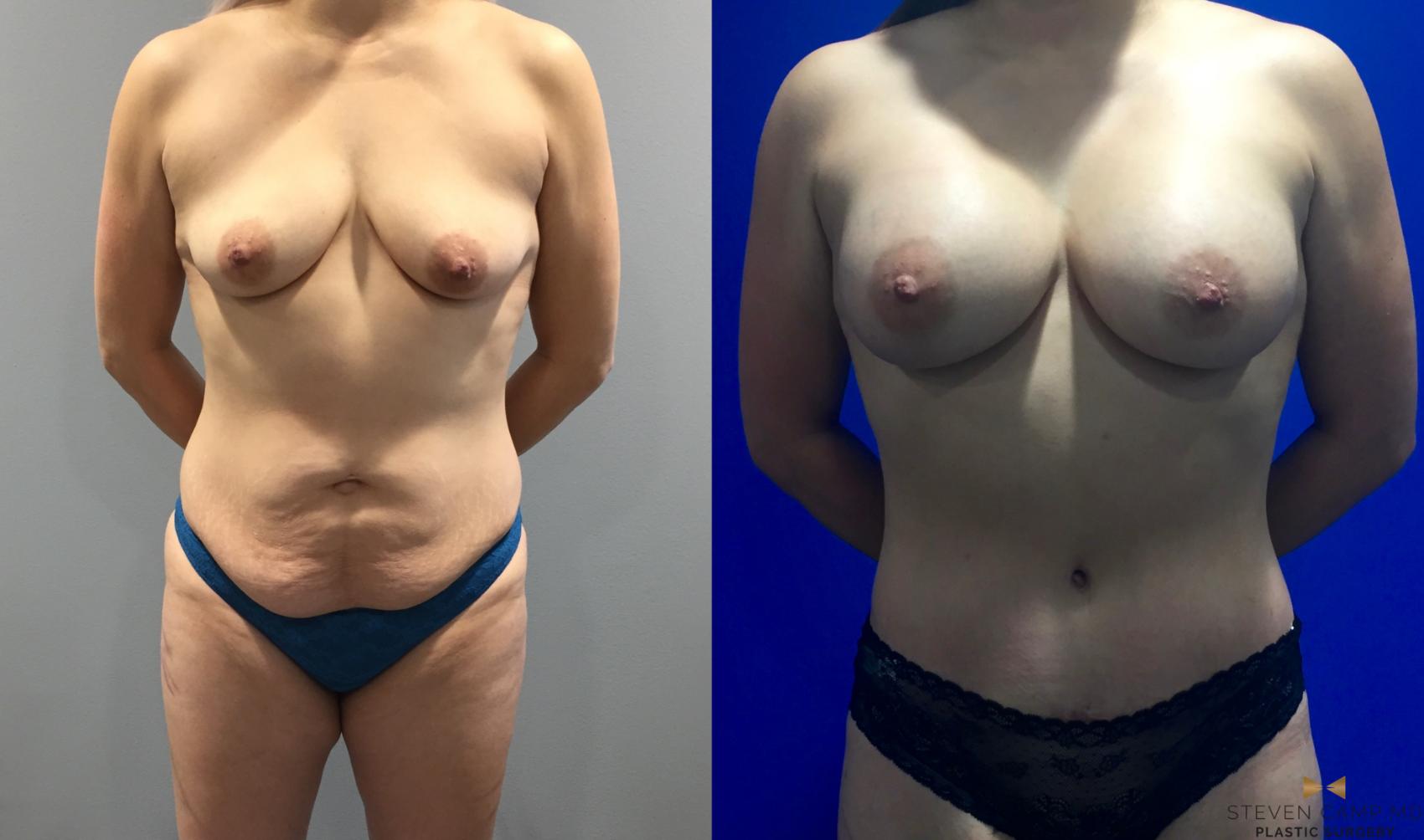 Before & After Liposuction Case 92 View #1 View in Fort Worth & Arlington, Texas