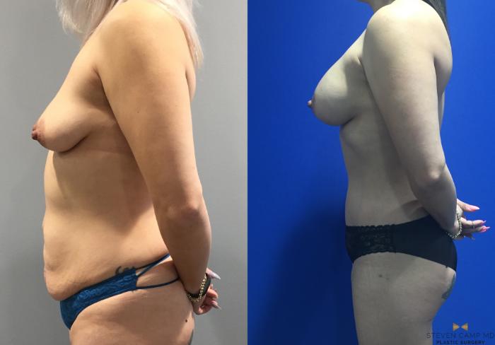 Before & After Breast Augmentation Case 92 View #2 View in Fort Worth & Arlington, Texas