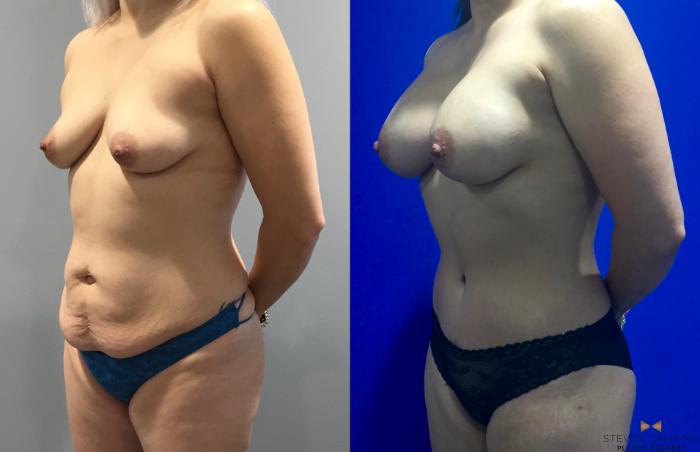 Before & After Breast Augmentation Case 92 View #3 View in Fort Worth & Arlington, Texas