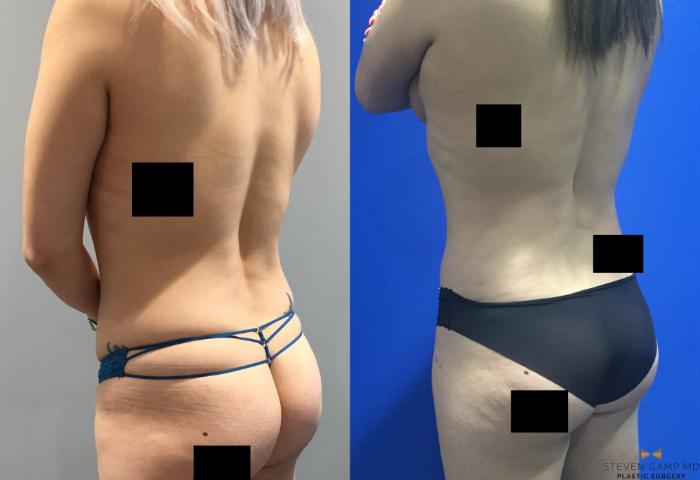 Before & After Tummy Tuck Case 92 View #4 View in Fort Worth & Arlington, Texas