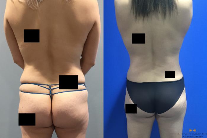 Before & After Breast Augmentation Case 92 View #5 View in Fort Worth & Arlington, Texas