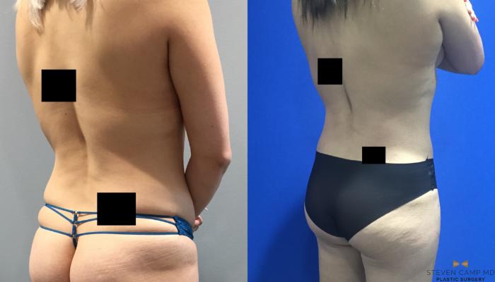 Before & After Breast Augmentation Case 92 View #6 View in Fort Worth & Arlington, Texas