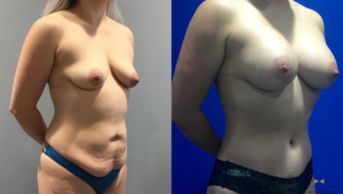 Before & After Tummy Tuck Case 92 View #7 View in Fort Worth & Arlington, Texas