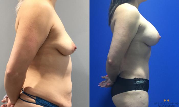 Before & After Tummy Tuck Case 92 View #8 View in Fort Worth & Arlington, Texas