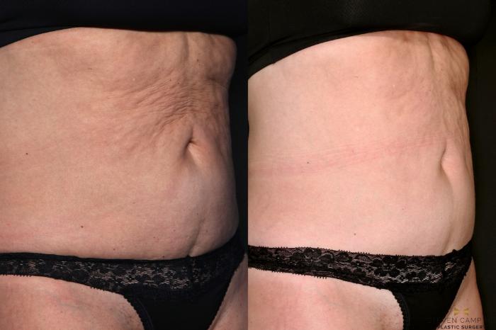 Before & After Morpheus8 Case 685 Right Oblique View in Fort Worth & Arlington, Texas