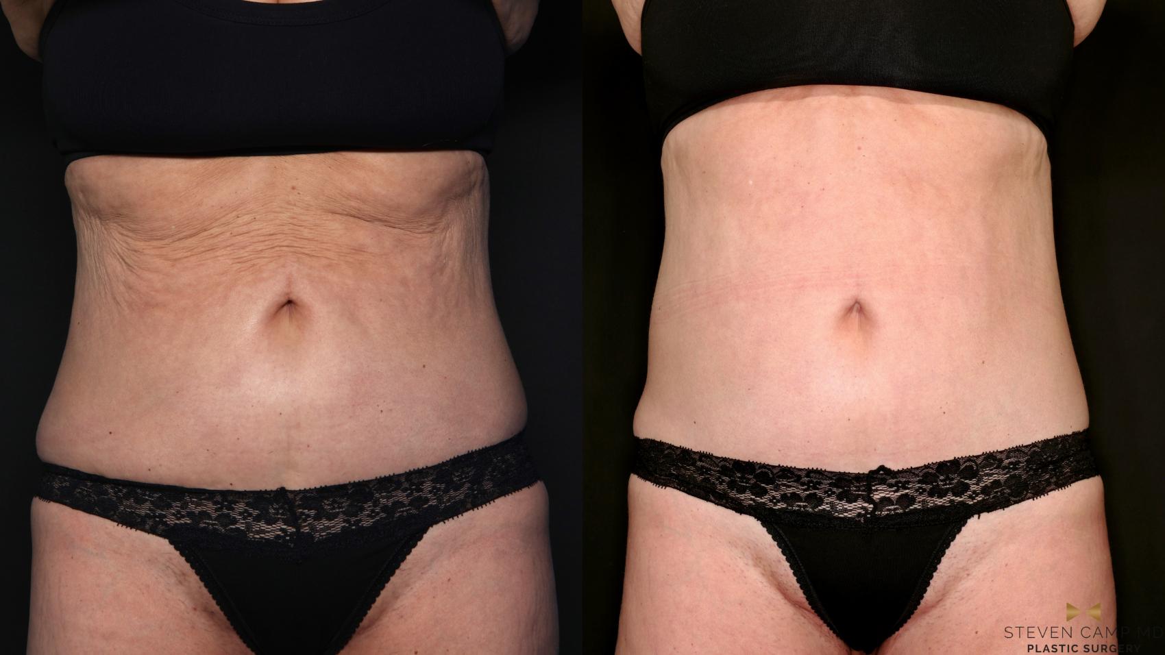 Before & After Morpheus8 RF Microneedling Case 685 Front View in Fort Worth & Arlington, Texas
