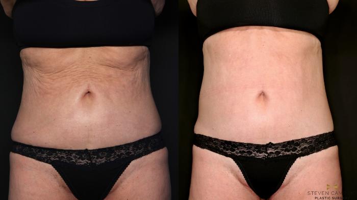 Before & After Morpheus8 RF Microneedling Case 685 Front View in Fort Worth & Arlington, Texas