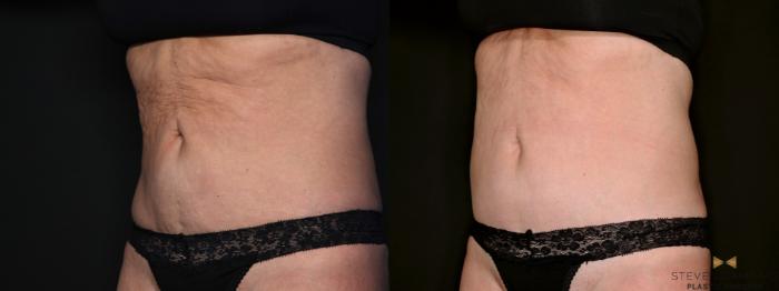 Before & After Morpheus8 RF Microneedling Case 685 Left Oblique View in Fort Worth & Arlington, Texas