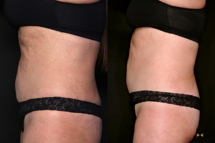 Before & After Morpheus8 RF Microneedling Case 685 Left Side View in Fort Worth & Arlington, Texas
