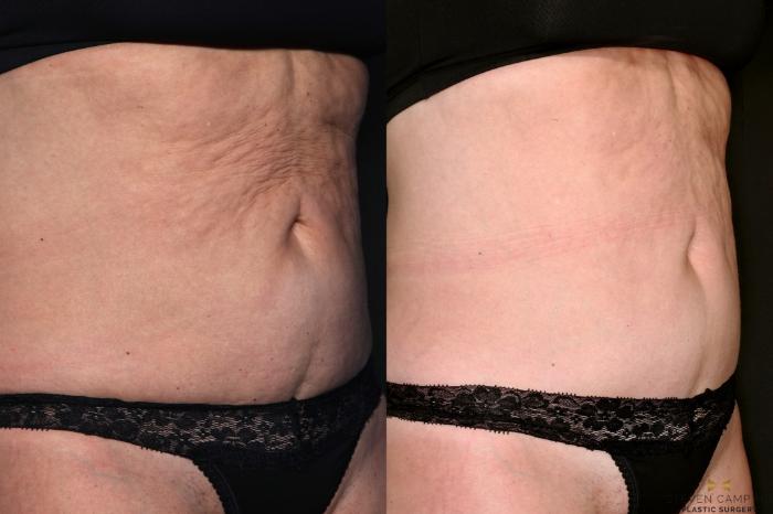 Before & After Morpheus8 RF Microneedling Case 685 Right Oblique View in Fort Worth & Arlington, Texas