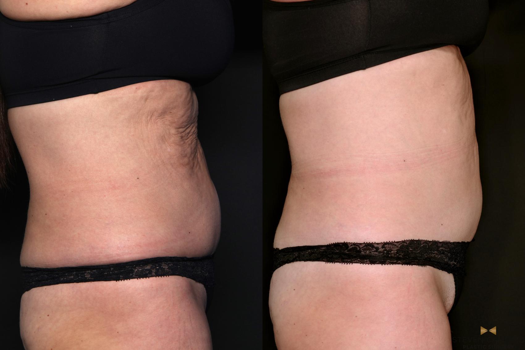 Before & After Morpheus8 RF Microneedling Case 685 Right Side View in Fort Worth & Arlington, Texas
