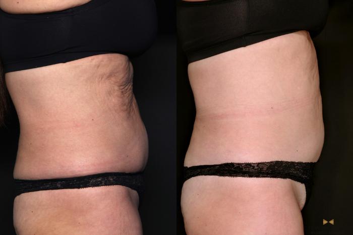 Before & After Morpheus8 RF Microneedling Case 685 Right Side View in Fort Worth & Arlington, Texas