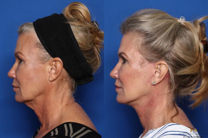 Before & After Necklift Case 469 Left Side View in Fort Worth & Arlington, Texas