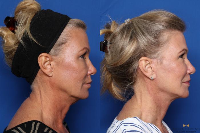 Before & After Necklift Case 469 Right Side View in Fort Worth & Arlington, Texas