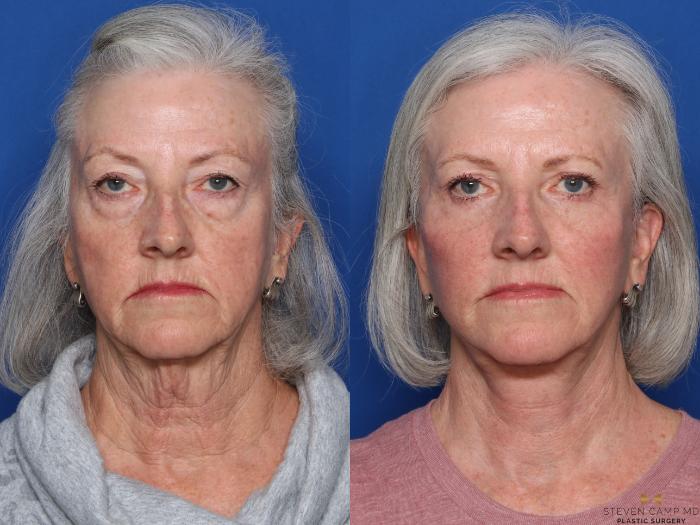 Before & After Sciton Laser Case 473 Front View in Fort Worth & Arlington, Texas