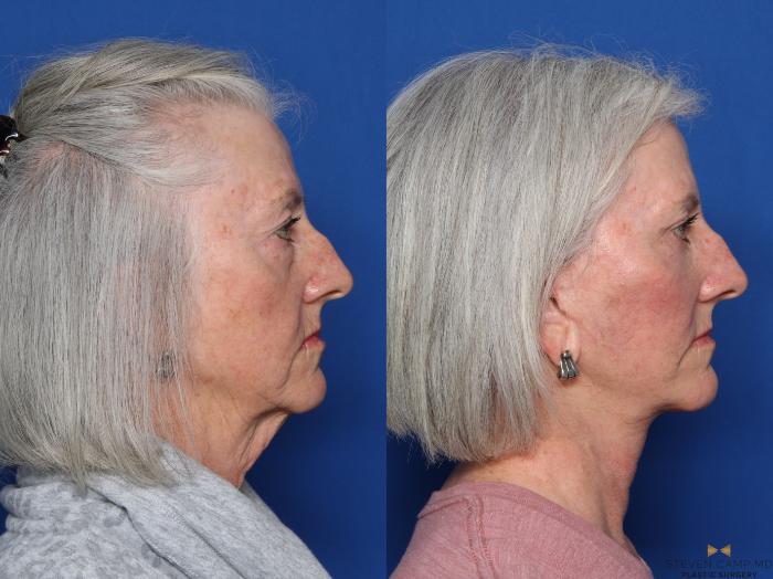 Before & After Sciton Laser Case 473 Right Side View in Fort Worth & Arlington, Texas