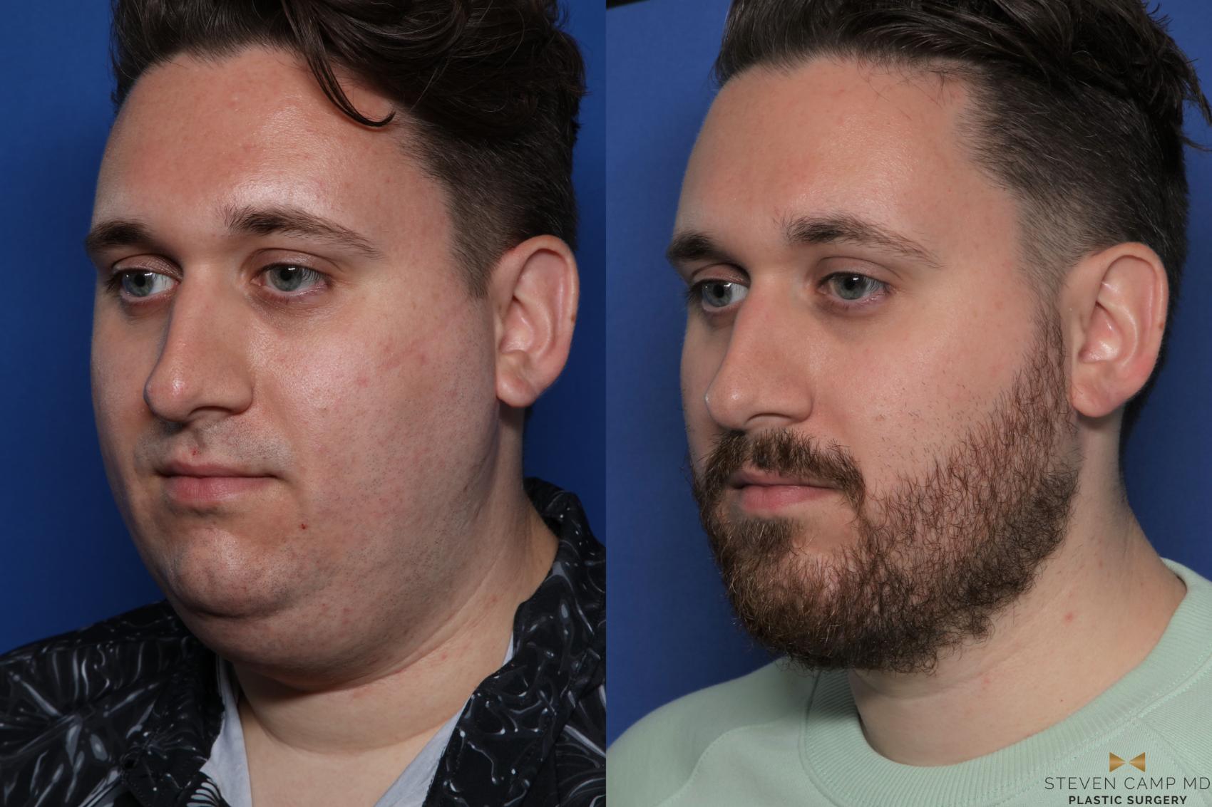 Before & After Chin Implant Case 556 Left Oblique View in Fort Worth & Arlington, Texas