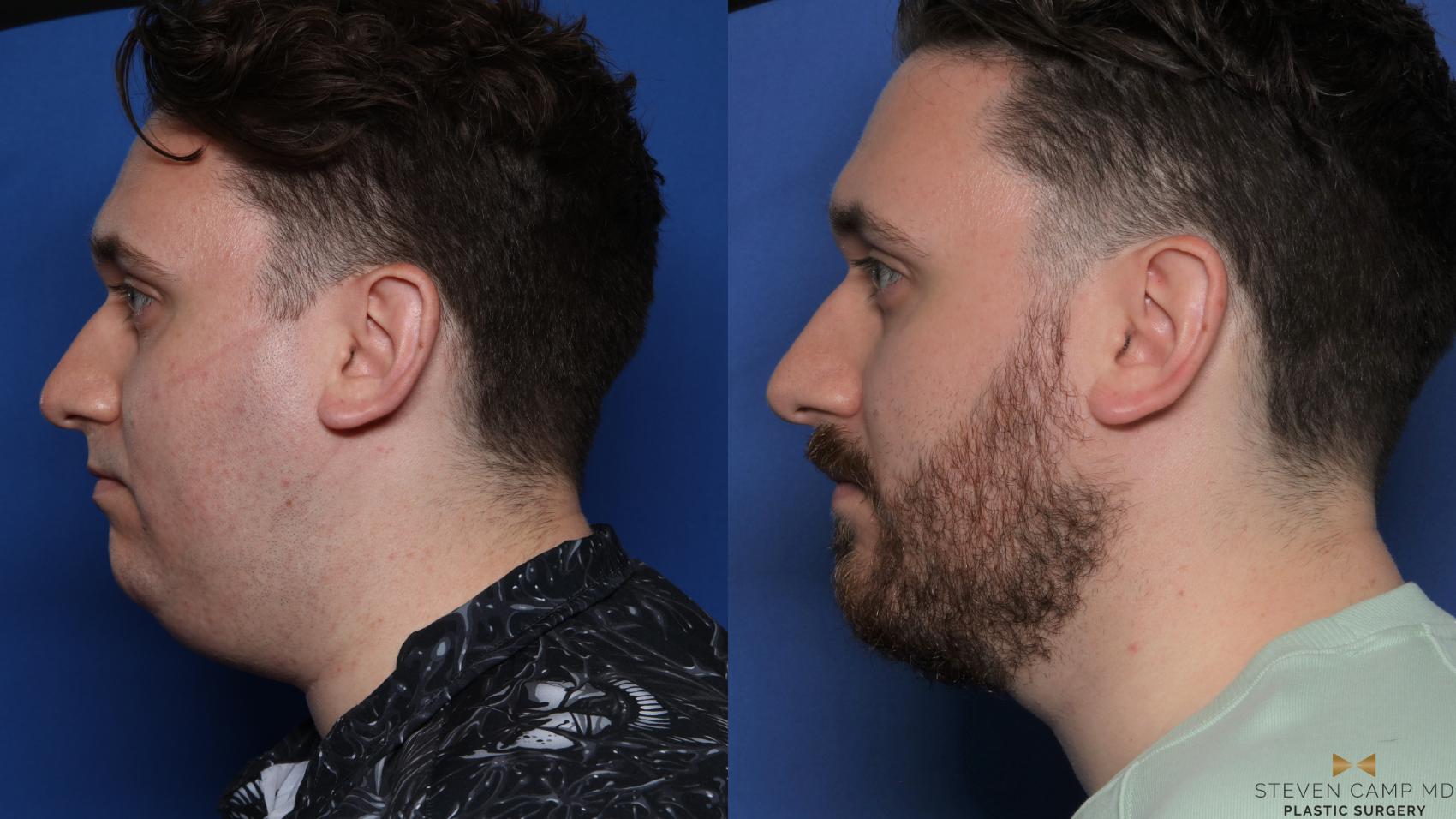Before & After Chin Implant Case 556 Left Side View in Fort Worth & Arlington, Texas