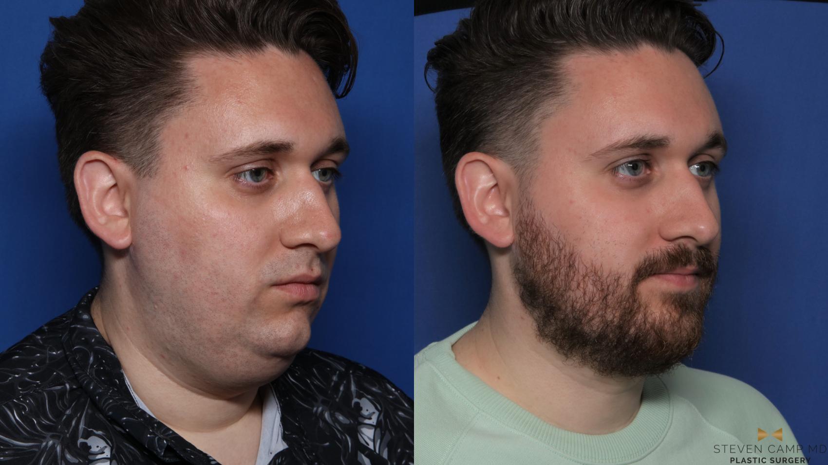 Before & After Chin Implant Case 556 Right Oblique View in Fort Worth & Arlington, Texas
