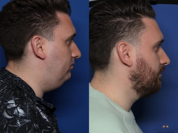 Before & After Chin Implant Case 556 Right Side View in Fort Worth & Arlington, Texas