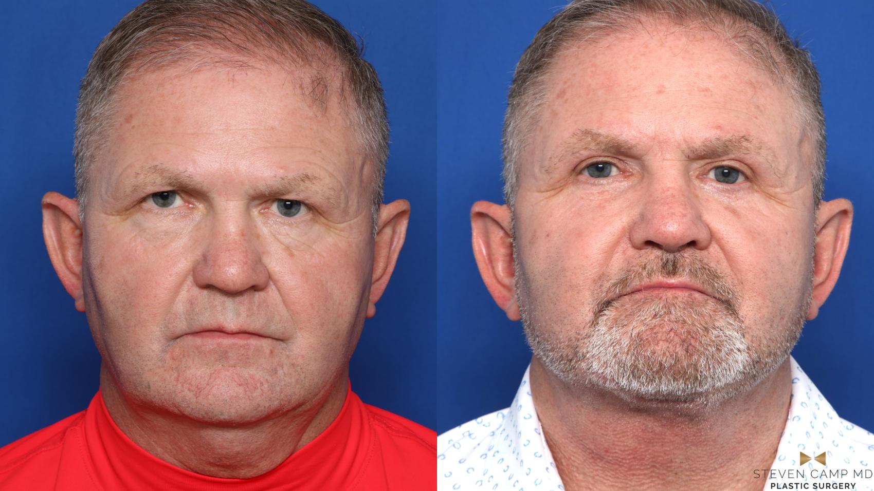 Before & After Necklift Case 609 Front View in Fort Worth & Arlington, Texas