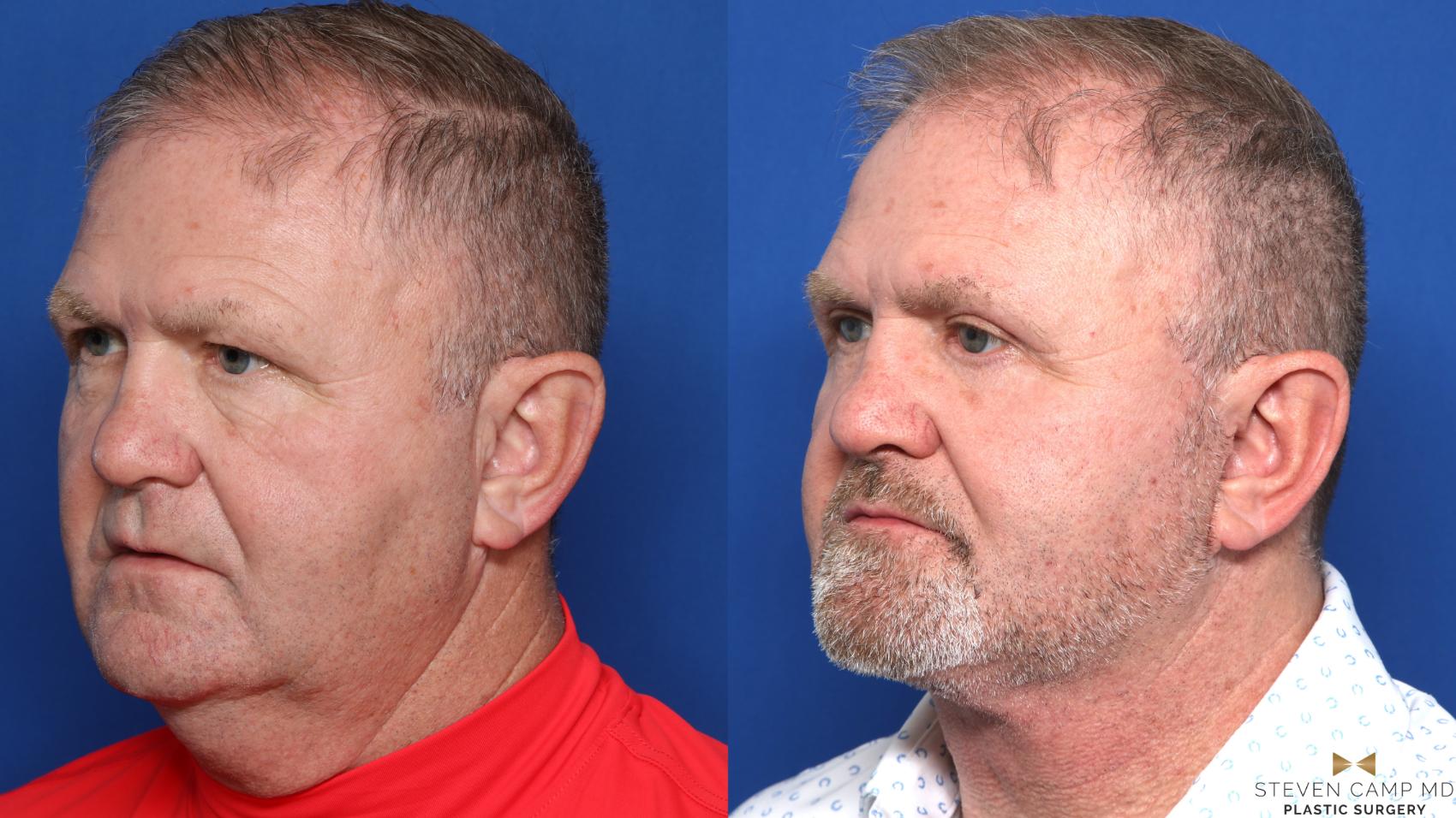 Before & After Necklift Case 609 Left Oblique View in Fort Worth & Arlington, Texas