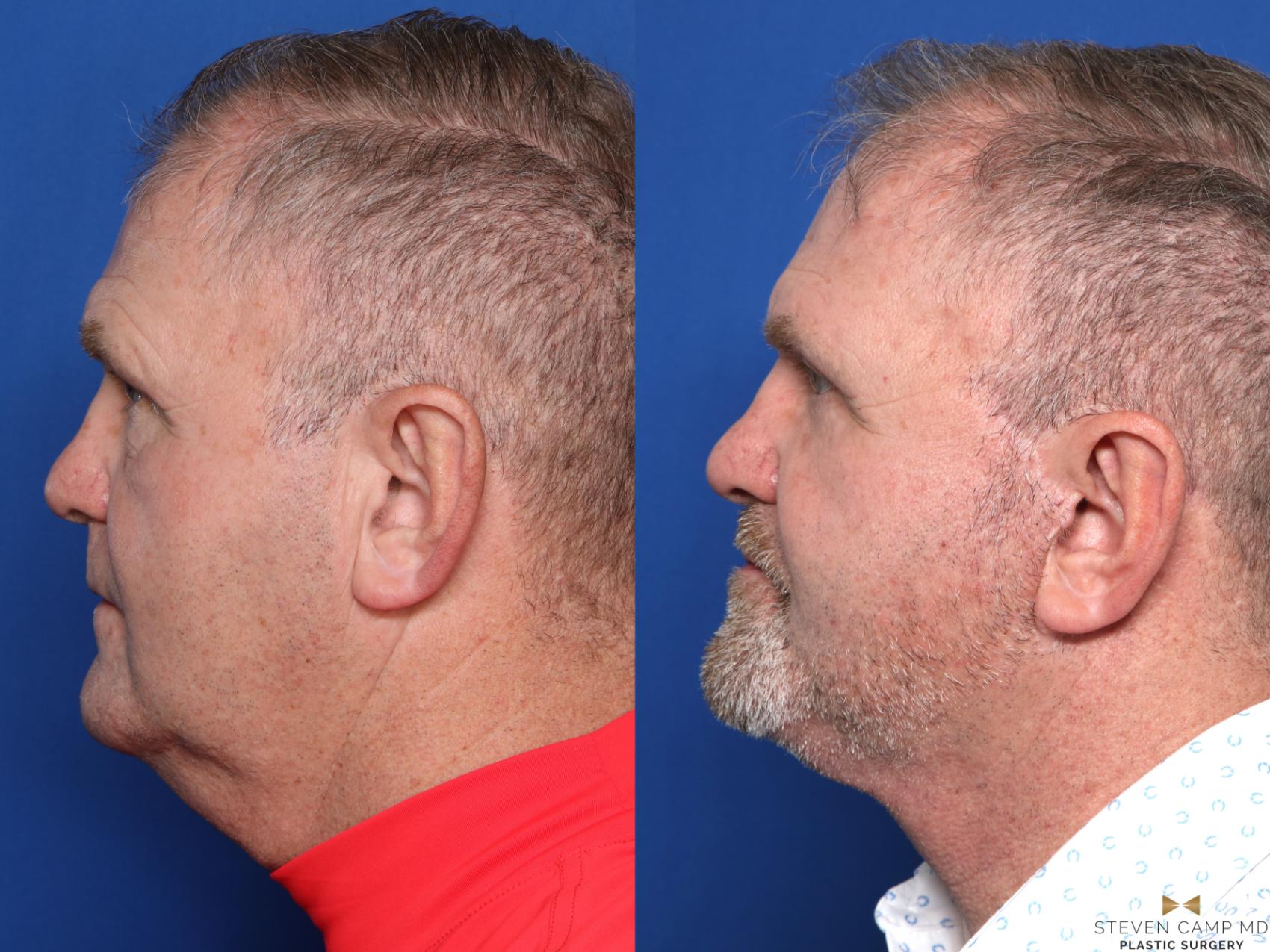 Before & After Necklift Case 609 Left Side View in Fort Worth & Arlington, Texas