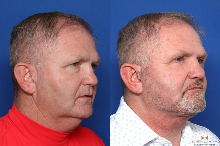 Before & After Necklift Case 609 Right Oblique View in Fort Worth & Arlington, Texas