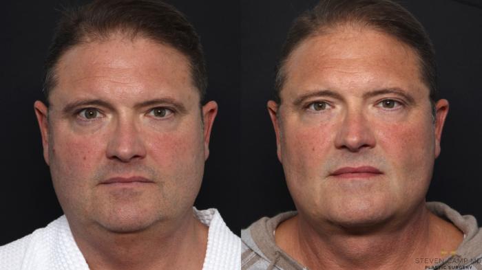 Before & After Necklift Case 670 Front View in Fort Worth & Arlington, Texas