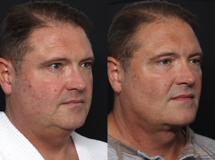 Before Neck Lift and Buccal Fat Pad Removal